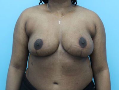 Breast Reduction