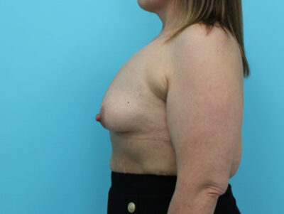 Augmentation & Mastopexy