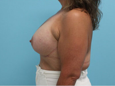 Augmentation & Mastopexy