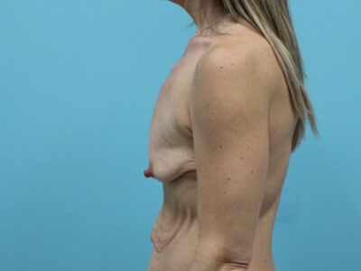 Augmentation & Mastopexy