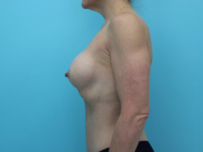 Breast Augmentation