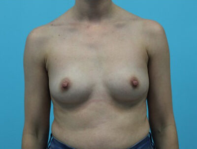 Breast Augmentation