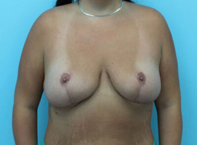 Mastopexy