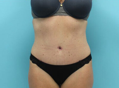 Abdominoplasty