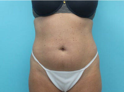 Abdominoplasty