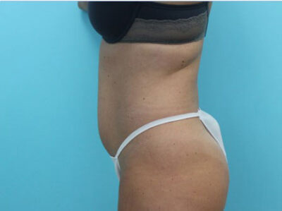 Abdominoplasty