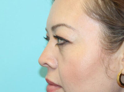 Blepharoplasty