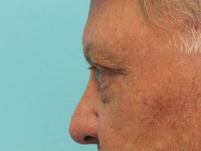 Blepharoplasty