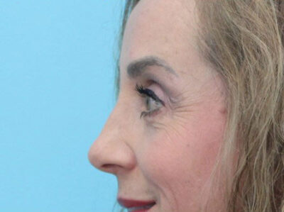 Blepharoplasty