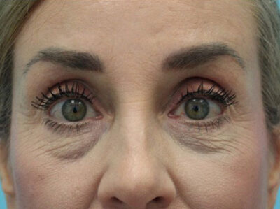 Blepharoplasty