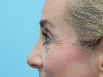 Blepharoplasty