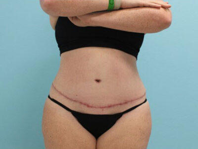 Abdominoplasty