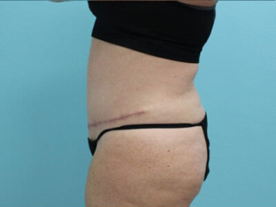 Abdominoplasty