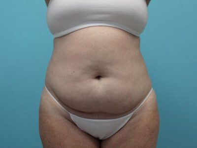 Abdominoplasty