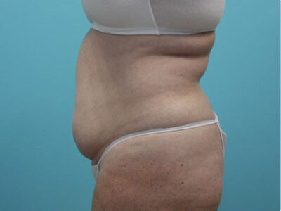 Abdominoplasty