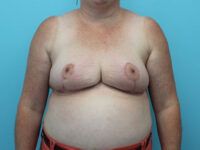 Breast Reduction