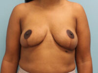 Breast Reduction