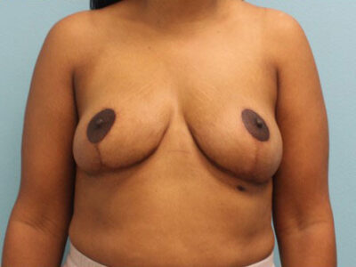 Breast Reduction