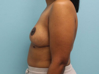 Breast Reduction