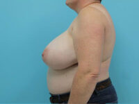 Breast Reduction