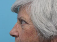 Blepharoplasty